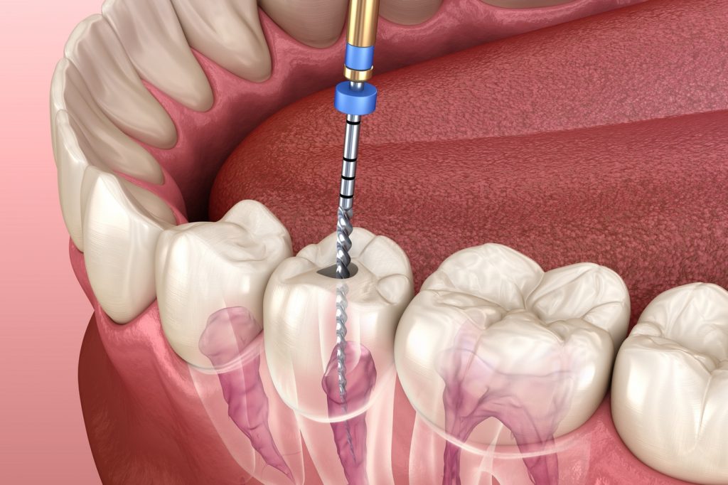 endodontie DENTAL LEMAN