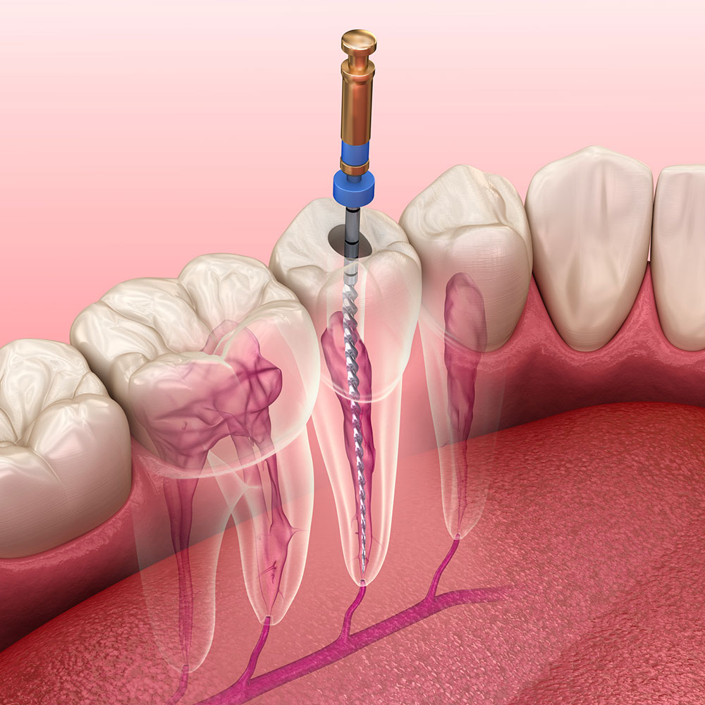 endodontie DENTAL LEMAN