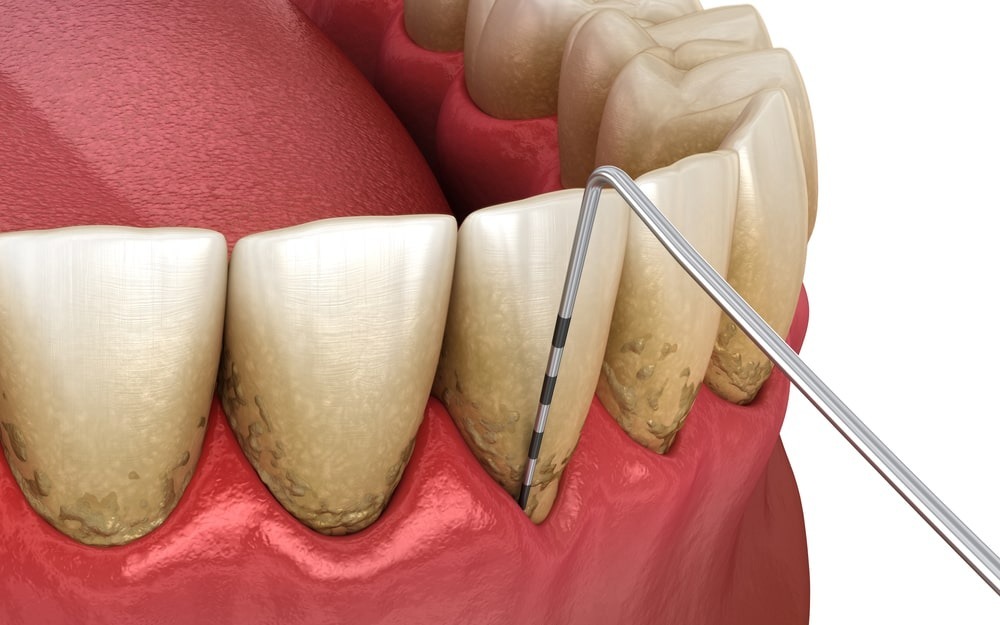 parodontologie dental leman cabinet dentaire vetraz-monthoux